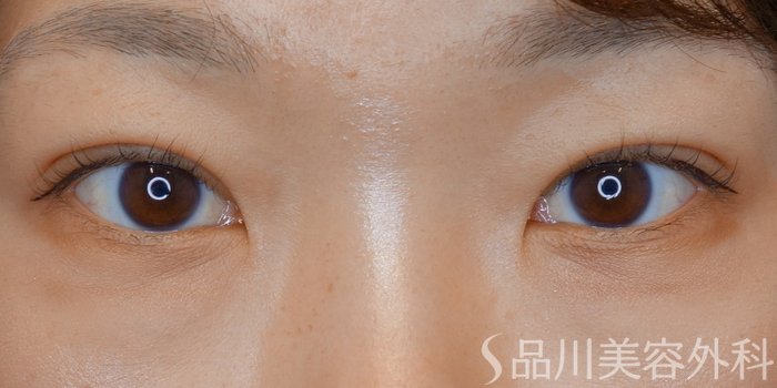 症例NO.71685のAFTER写真