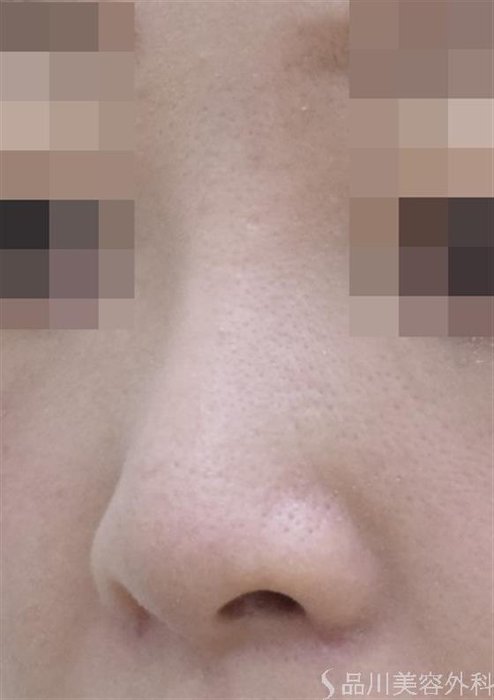 症例NO.48541のAFTER写真