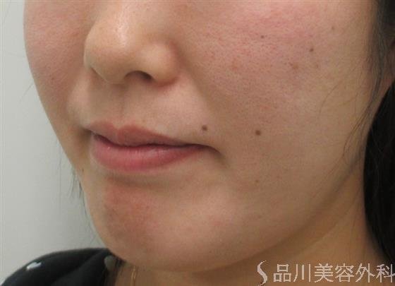 症例NO.20223のBEFORE写真