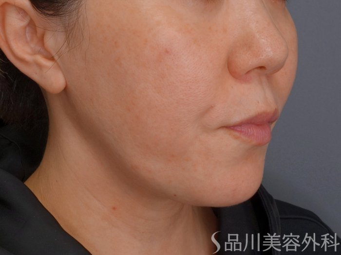 症例NO.75069のBEFORE写真