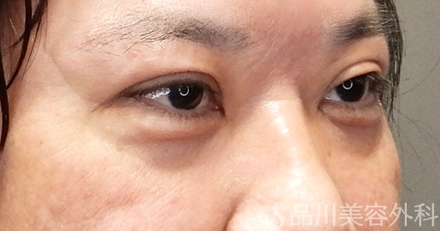 症例NO.68463のAFTER写真