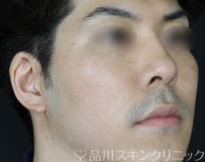 症例NO.69565のAFTER写真