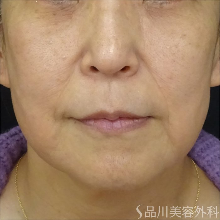 症例NO.69322のBEFORE写真