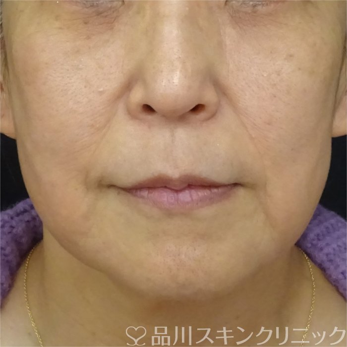 症例NO.69322のBEFORE写真