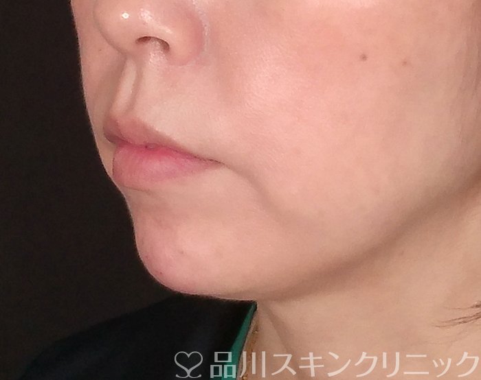 症例NO.70079のAFTER写真
