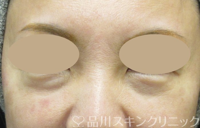 症例NO.73966のBEFORE写真