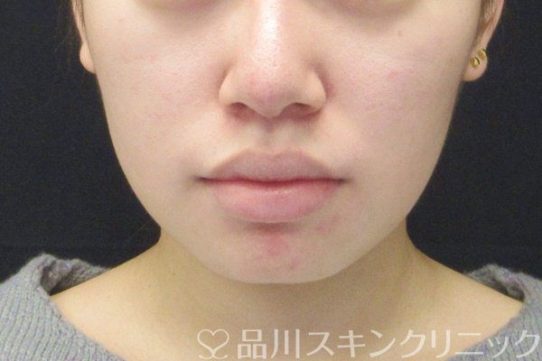 症例NO.65040のBEFORE写真