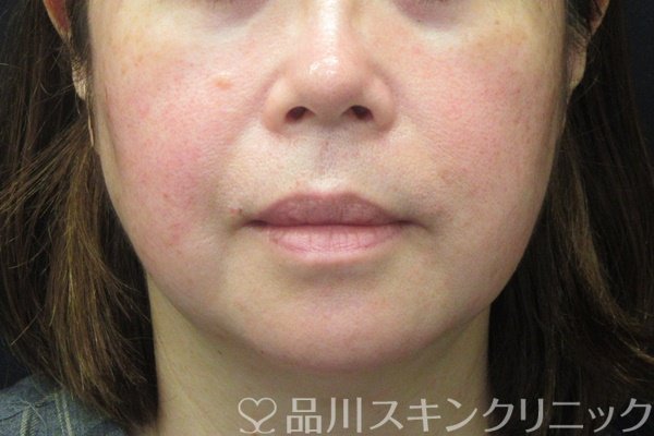 症例NO.67978のBEFORE写真