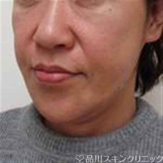 症例NO.38770のAFTER写真