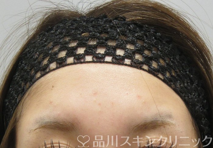 症例NO.74522のBEFORE写真
