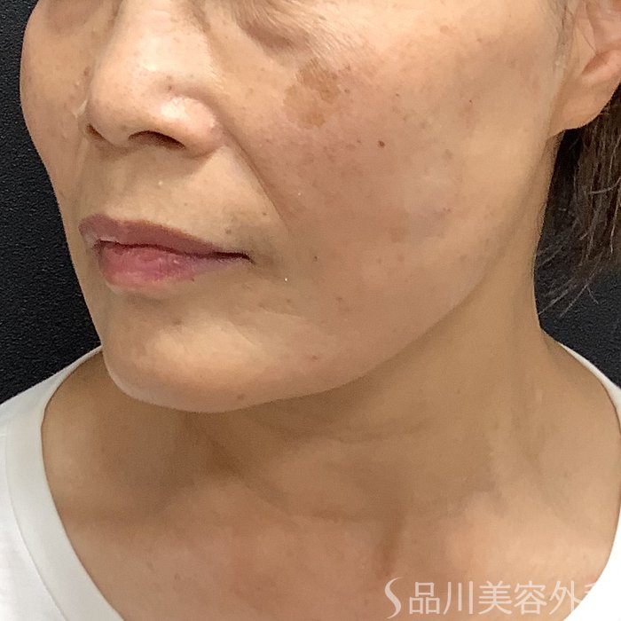 症例NO.75395のAFTER写真