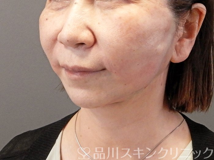 症例NO.66252のAFTER写真