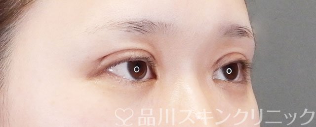 症例NO.75272のAFTER写真