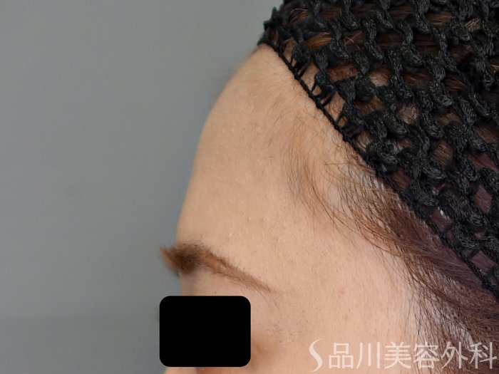 症例NO.70854のBEFORE写真