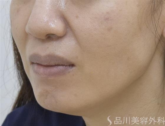 症例NO.51623のBEFORE写真