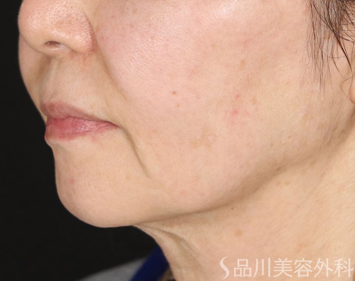 症例NO.72741のBEFORE写真