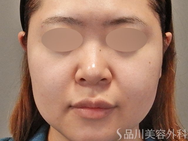 症例NO.75108のBEFORE写真