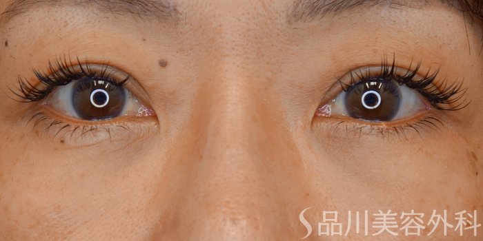 症例NO.70802のBEFORE写真