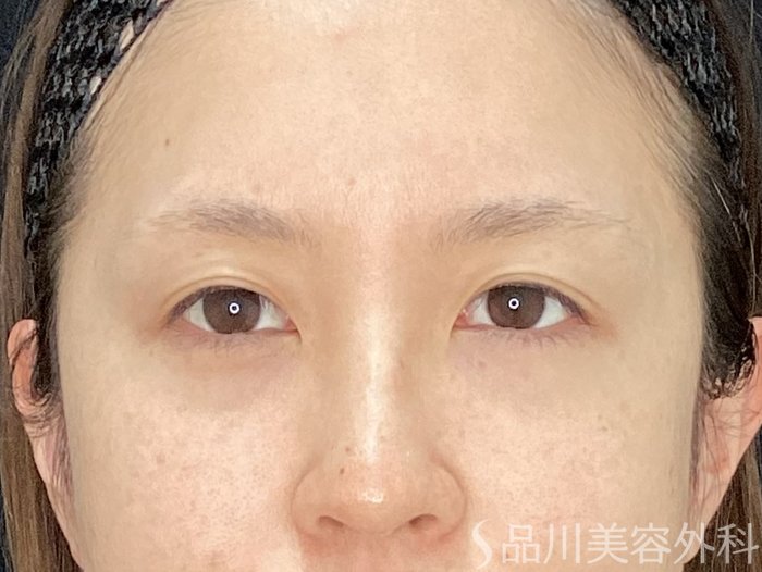 症例NO.71147のBEFORE写真