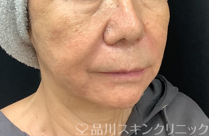 症例NO.67983のAFTER写真