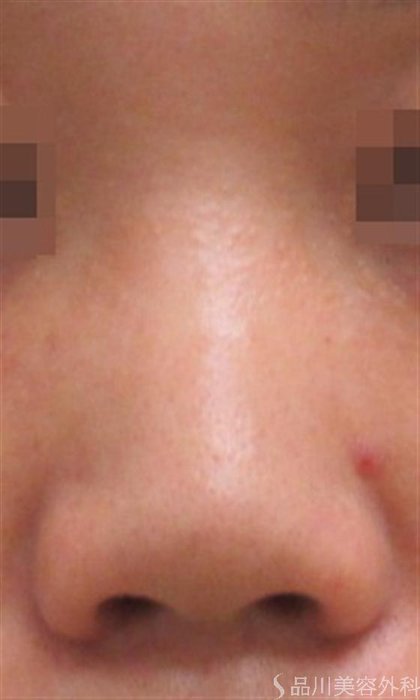 症例NO.19202のBEFORE写真
