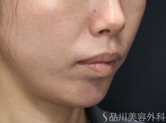 症例NO.75361のAFTER写真