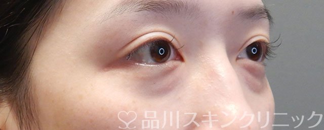 症例NO.71913のBEFORE写真