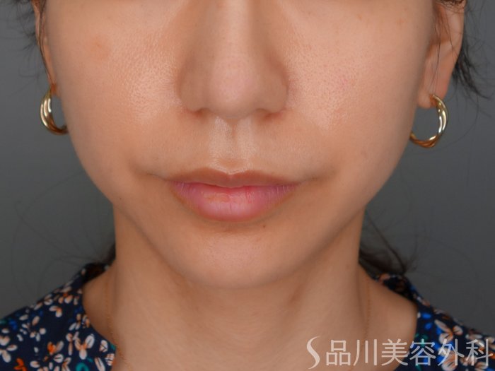 症例NO.73196のBEFORE写真