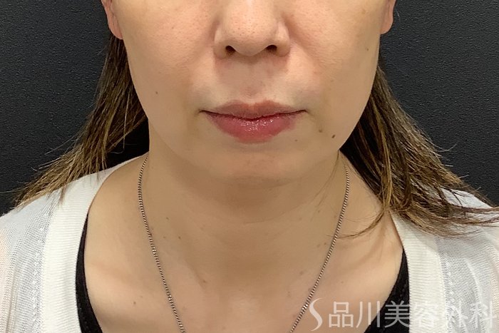 症例NO.75291のBEFORE写真