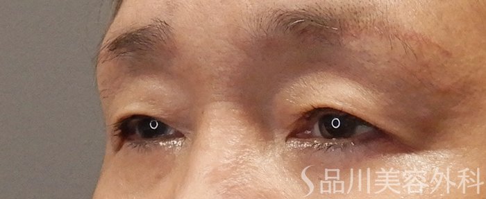 症例NO.71383のBEFORE写真