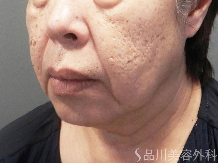 症例NO.71431のBEFORE写真