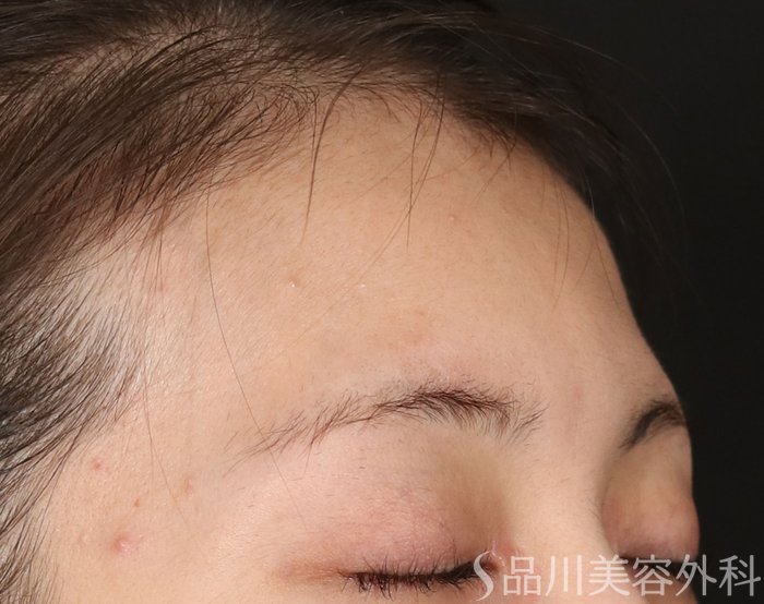 症例NO.71823のBEFORE写真