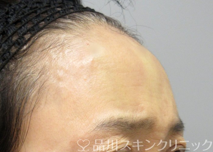 症例NO.72747のAFTER写真