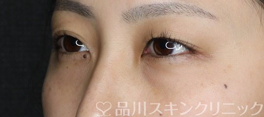 症例NO.73588のBEFORE写真