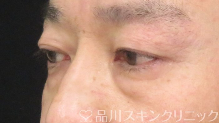 症例NO.69714のBEFORE写真