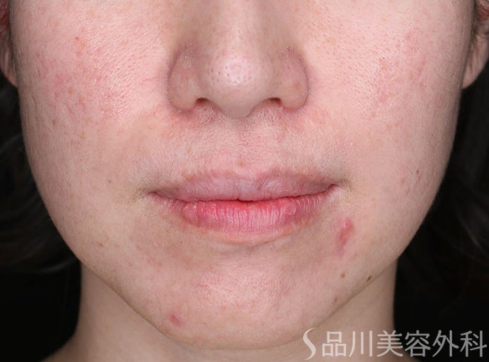 症例NO.72595のBEFORE写真