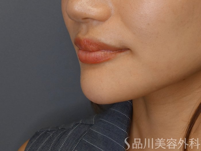 症例NO.71489のAFTER写真
