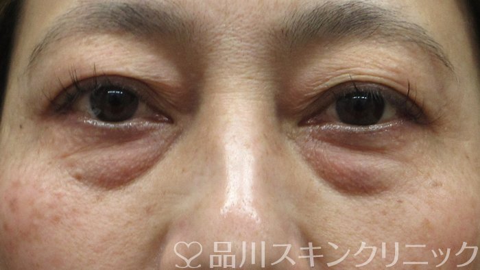 症例NO.70506のBEFORE写真