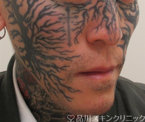 症例NO.26721のAFTER写真