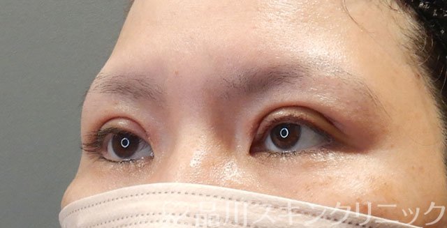 症例NO.75077のAFTER写真