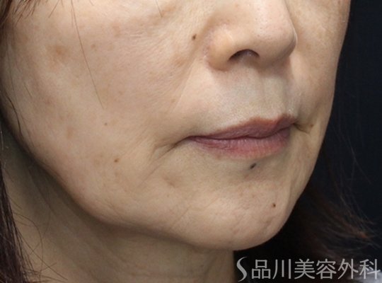 症例NO.75105のBEFORE写真