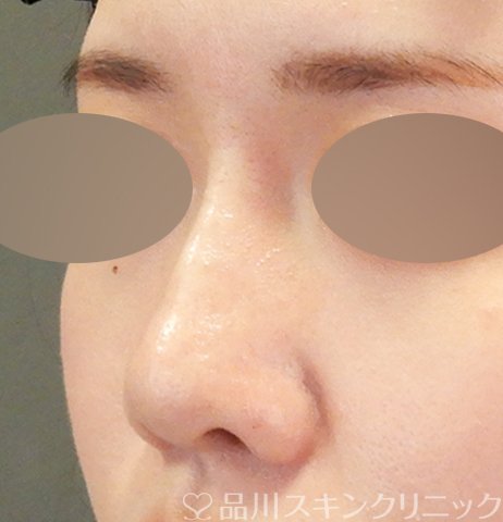 症例NO.64565のAFTER写真