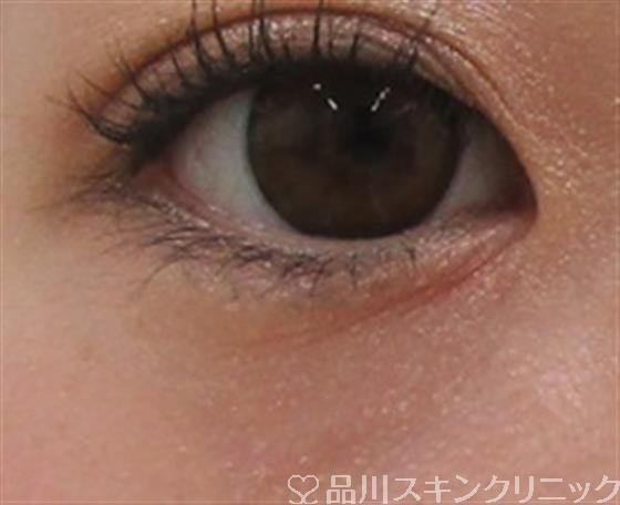 症例NO.38810のBEFORE写真