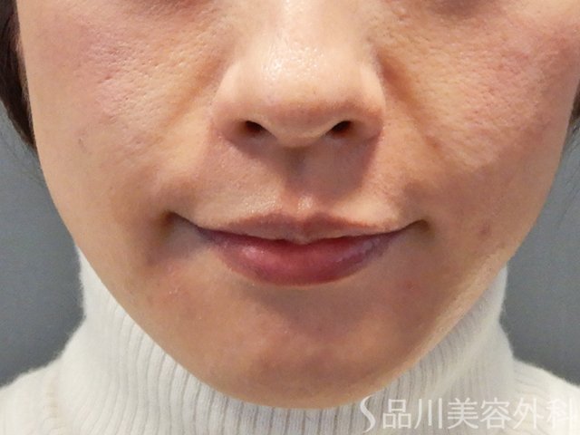 症例NO.69626のBEFORE写真