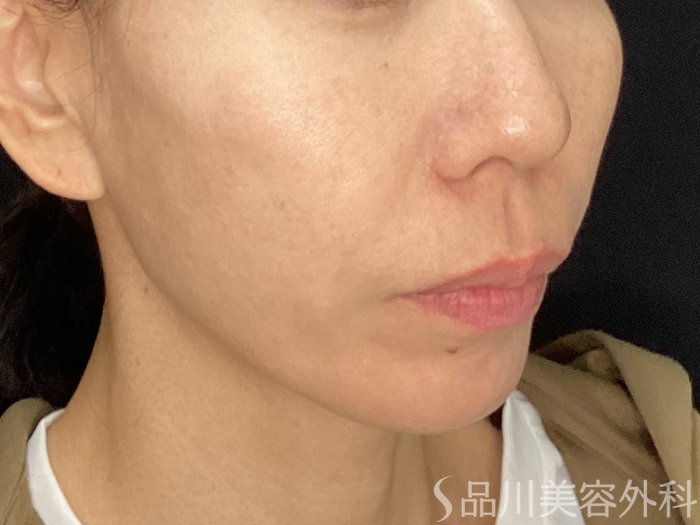 症例NO.72733のAFTER写真