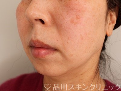 症例NO.75117のAFTER写真