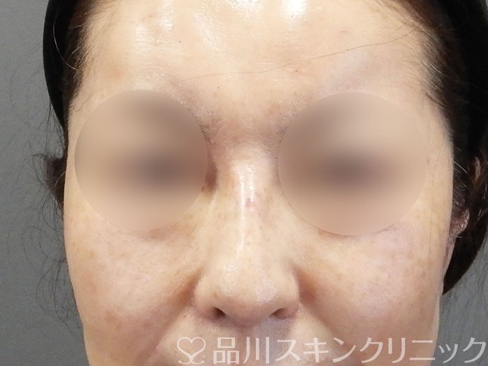 症例NO.75043のAFTER写真