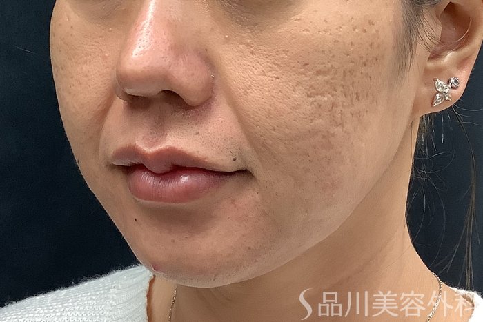 症例NO.73310のBEFORE写真