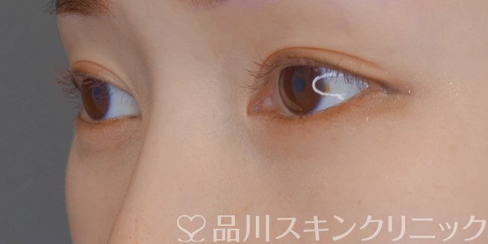 症例NO.72481のAFTER写真