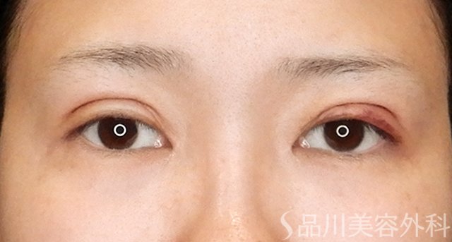 症例NO.75158のAFTER写真